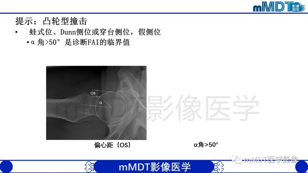 影像PPT - 【PPT】股骨髋臼撞击症影像学改变-17 影像PPT - 【PPT】股骨髋臼撞击症影像学改变-17