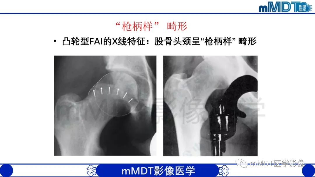 影像PPT - 【PPT】股骨髋臼撞击症影像学改变-18 影像PPT - 【PPT】股骨髋臼撞击症影像学改变-18