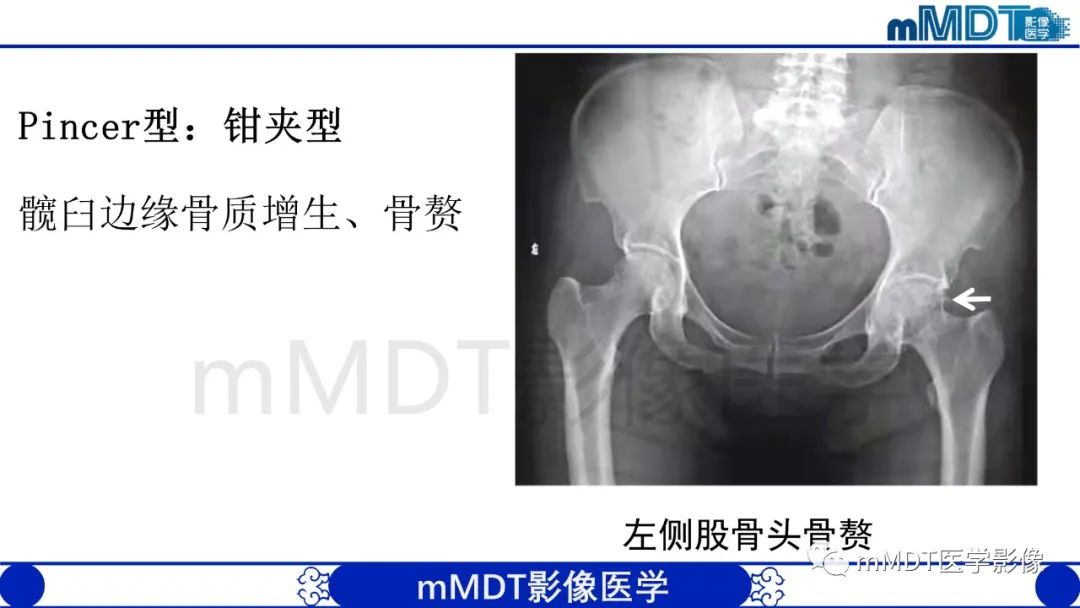影像PPT - 【PPT】股骨髋臼撞击症影像学改变-19 影像PPT - 【PPT】股骨髋臼撞击症影像学改变-19