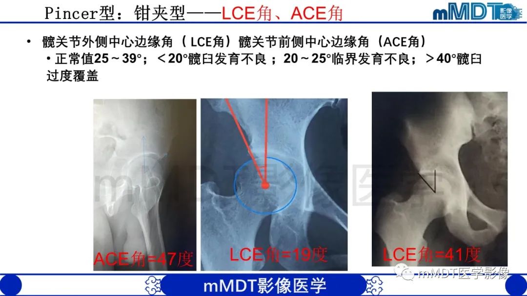 影像PPT - 【PPT】股骨髋臼撞击症影像学改变-20 影像PPT - 【PPT】股骨髋臼撞击症影像学改变-20