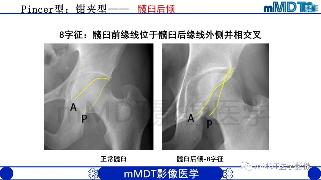 影像PPT - 【PPT】股骨髋臼撞击症影像学改变-21 影像PPT - 【PPT】股骨髋臼撞击症影像学改变-21