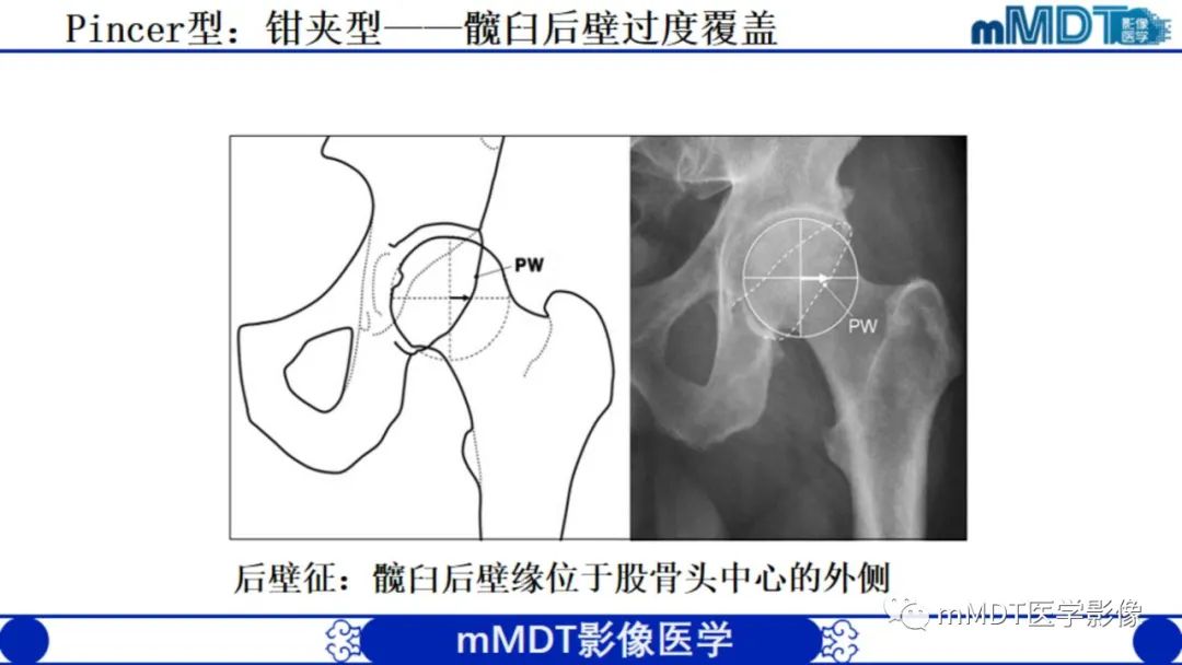 影像PPT - 【PPT】股骨髋臼撞击症影像学改变-22 影像PPT - 【PPT】股骨髋臼撞击症影像学改变-22