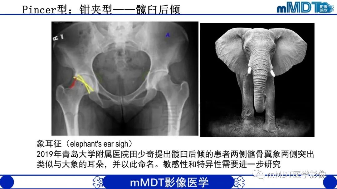 影像PPT - 【PPT】股骨髋臼撞击症影像学改变-23 影像PPT - 【PPT】股骨髋臼撞击症影像学改变-23