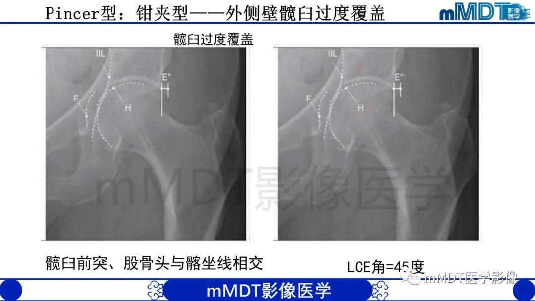 影像PPT - 【PPT】股骨髋臼撞击症影像学改变-24 影像PPT - 【PPT】股骨髋臼撞击症影像学改变-24