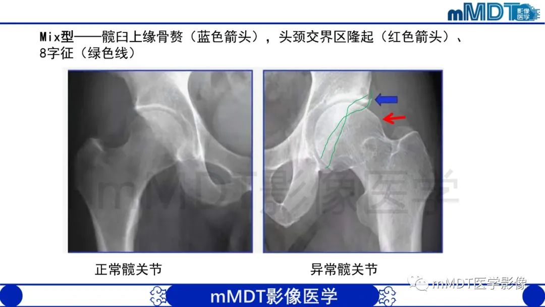 影像PPT - 【PPT】股骨髋臼撞击症影像学改变-25 影像PPT - 【PPT】股骨髋臼撞击症影像学改变-25