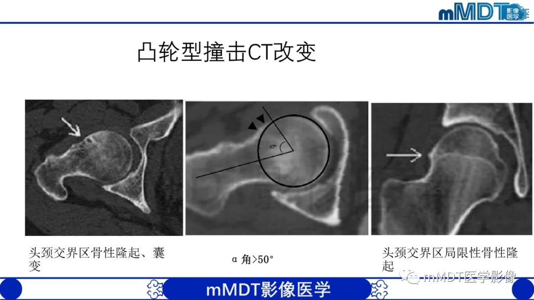 影像PPT - 【PPT】股骨髋臼撞击症影像学改变-28 影像PPT - 【PPT】股骨髋臼撞击症影像学改变-28