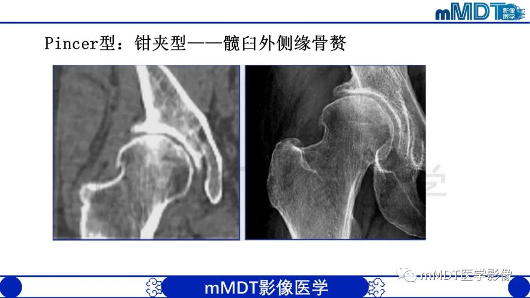 影像PPT - 【PPT】股骨髋臼撞击症影像学改变-30 影像PPT - 【PPT】股骨髋臼撞击症影像学改变-30