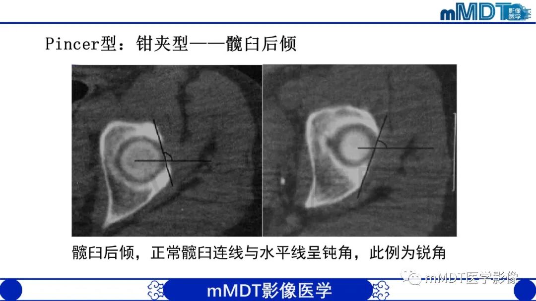 影像PPT - 【PPT】股骨髋臼撞击症影像学改变-29 影像PPT - 【PPT】股骨髋臼撞击症影像学改变-29