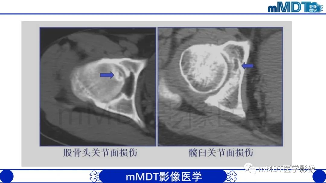 影像PPT - 【PPT】股骨髋臼撞击症影像学改变-27 影像PPT - 【PPT】股骨髋臼撞击症影像学改变-27