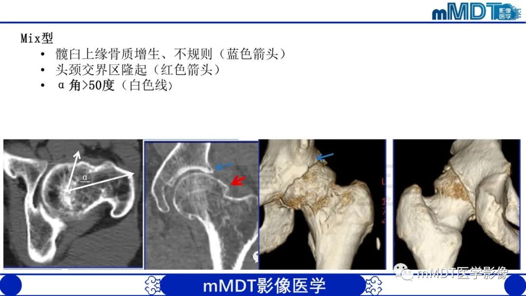 影像PPT - 【PPT】股骨髋臼撞击症影像学改变-31 影像PPT - 【PPT】股骨髋臼撞击症影像学改变-31