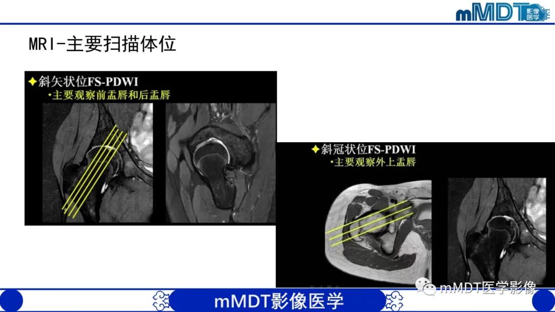 影像PPT - 【PPT】股骨髋臼撞击症影像学改变-33 影像PPT - 【PPT】股骨髋臼撞击症影像学改变-33