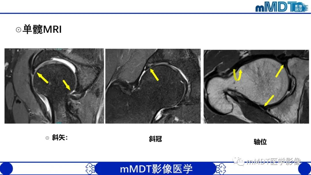 影像PPT - 【PPT】股骨髋臼撞击症影像学改变-34 影像PPT - 【PPT】股骨髋臼撞击症影像学改变-34