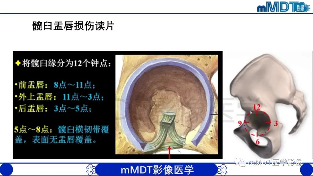 影像PPT - 【PPT】股骨髋臼撞击症影像学改变-35 影像PPT - 【PPT】股骨髋臼撞击症影像学改变-35