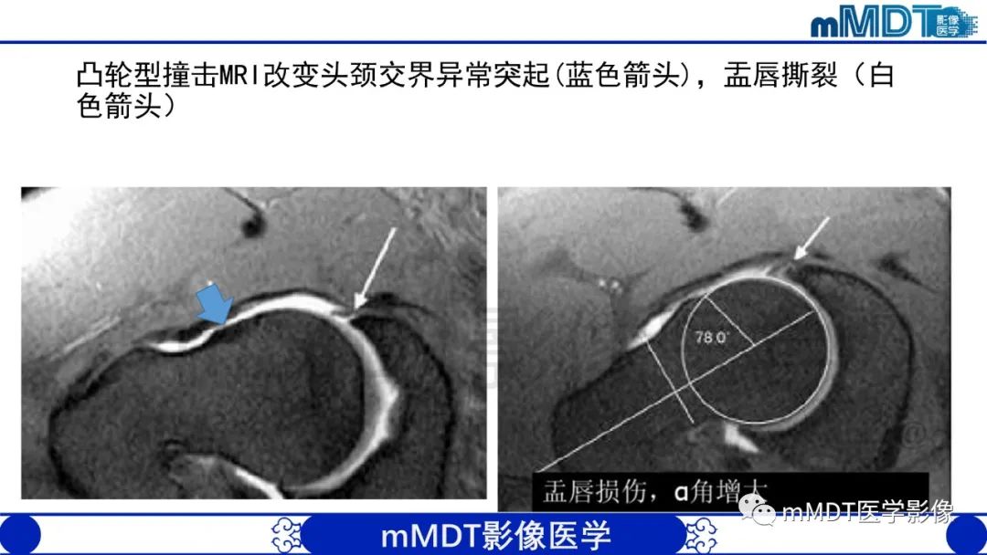 影像PPT - 【PPT】股骨髋臼撞击症影像学改变-36 影像PPT - 【PPT】股骨髋臼撞击症影像学改变-36