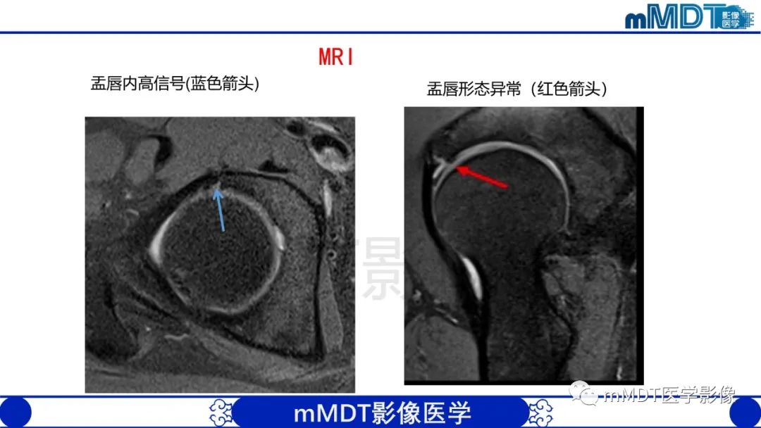 影像PPT - 【PPT】股骨髋臼撞击症影像学改变-37 影像PPT - 【PPT】股骨髋臼撞击症影像学改变-37