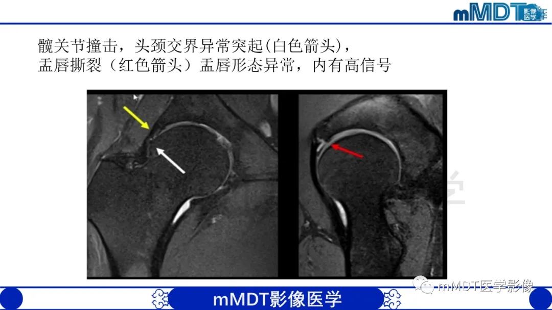影像PPT - 【PPT】股骨髋臼撞击症影像学改变-39 影像PPT - 【PPT】股骨髋臼撞击症影像学改变-39