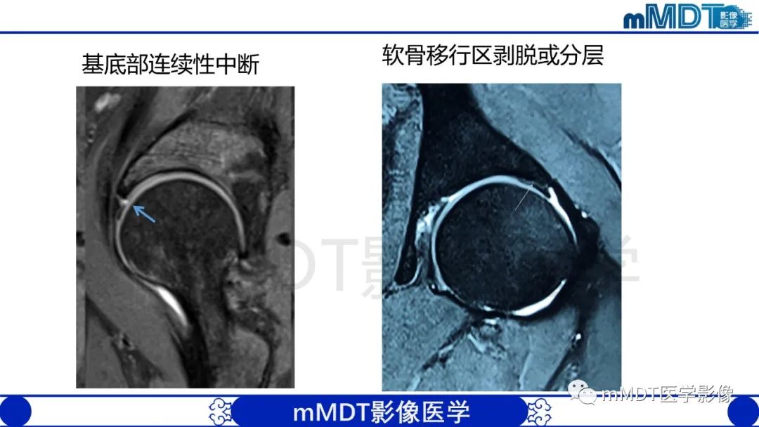 影像PPT - 【PPT】股骨髋臼撞击症影像学改变-38 影像PPT - 【PPT】股骨髋臼撞击症影像学改变-38