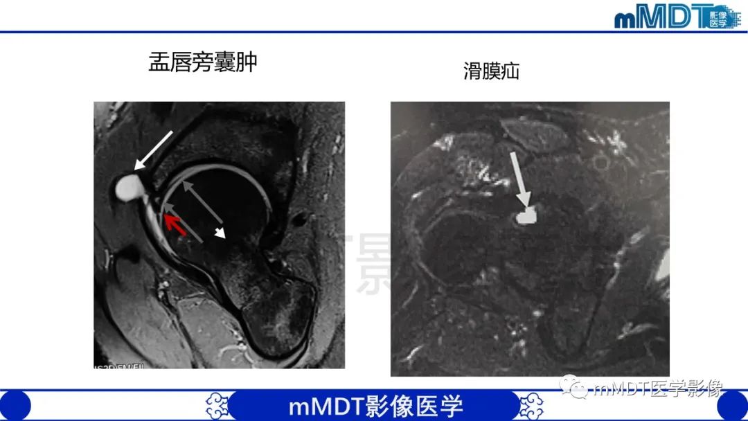 影像PPT - 【PPT】股骨髋臼撞击症影像学改变-40 影像PPT - 【PPT】股骨髋臼撞击症影像学改变-40