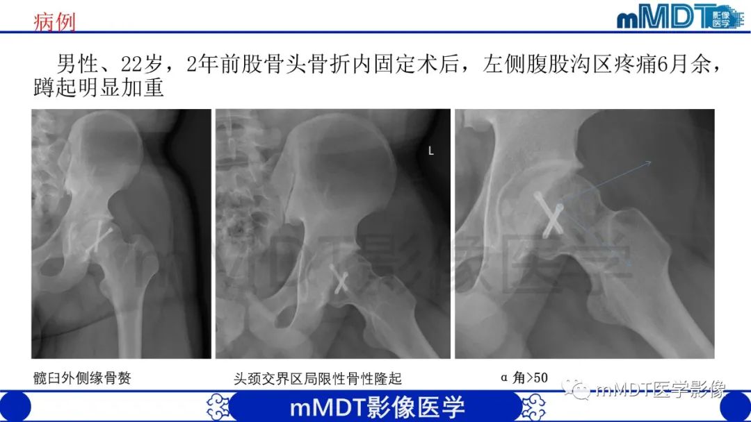 影像PPT - 【PPT】股骨髋臼撞击症影像学改变-41 影像PPT - 【PPT】股骨髋臼撞击症影像学改变-41