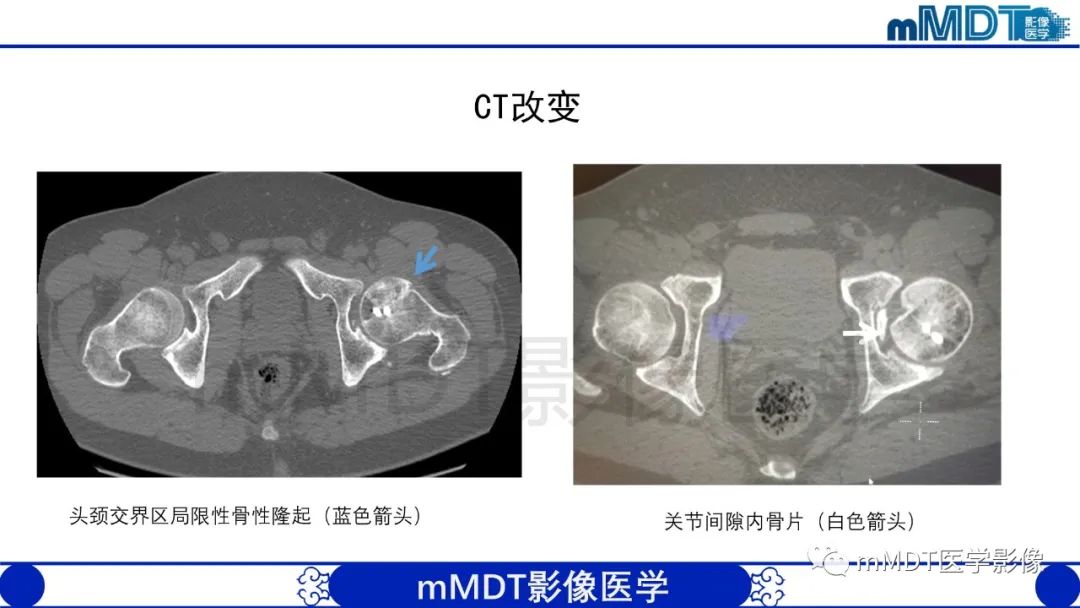 影像PPT - 【PPT】股骨髋臼撞击症影像学改变-42 影像PPT - 【PPT】股骨髋臼撞击症影像学改变-42