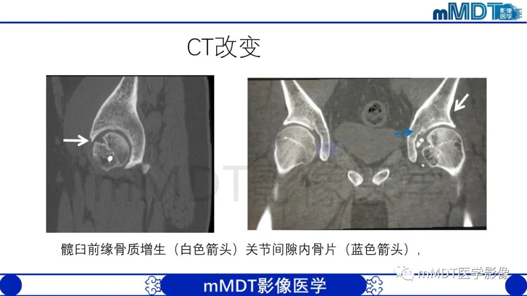 影像PPT - 【PPT】股骨髋臼撞击症影像学改变-43 影像PPT - 【PPT】股骨髋臼撞击症影像学改变-43
