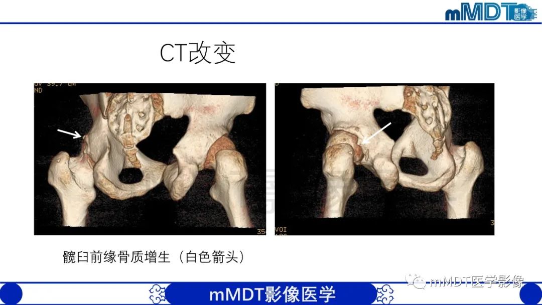 影像PPT - 【PPT】股骨髋臼撞击症影像学改变-44 影像PPT - 【PPT】股骨髋臼撞击症影像学改变-44