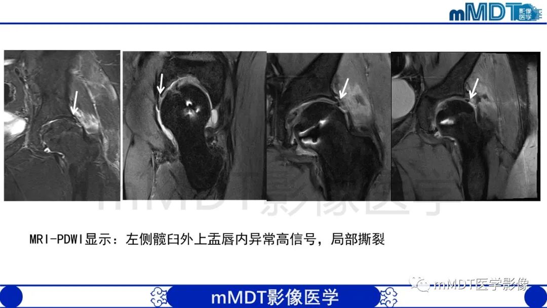 影像PPT - 【PPT】股骨髋臼撞击症影像学改变-45 影像PPT - 【PPT】股骨髋臼撞击症影像学改变-45