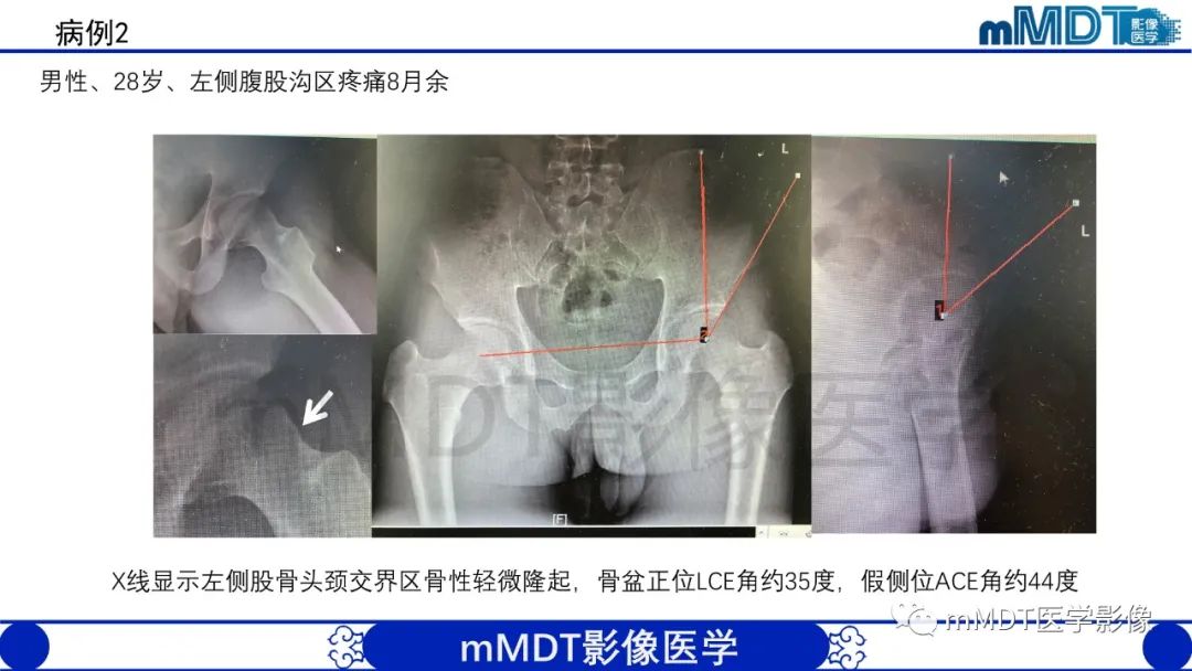 影像PPT - 【PPT】股骨髋臼撞击症影像学改变-47 影像PPT - 【PPT】股骨髋臼撞击症影像学改变-47
