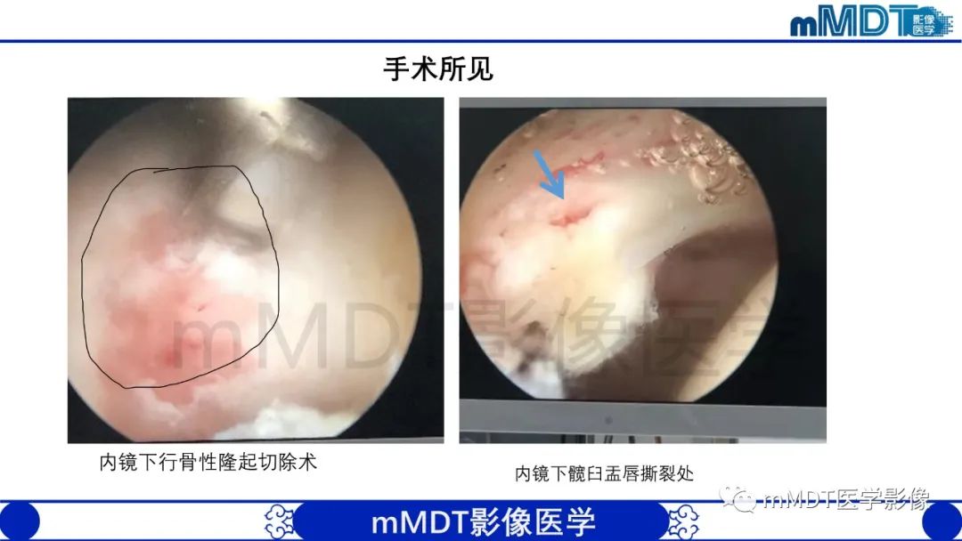 影像PPT - 【PPT】股骨髋臼撞击症影像学改变-46 影像PPT - 【PPT】股骨髋臼撞击症影像学改变-46