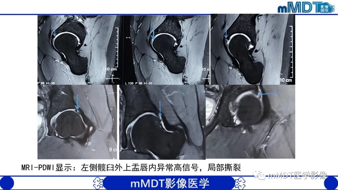 影像PPT - 【PPT】股骨髋臼撞击症影像学改变-48 影像PPT - 【PPT】股骨髋臼撞击症影像学改变-48
