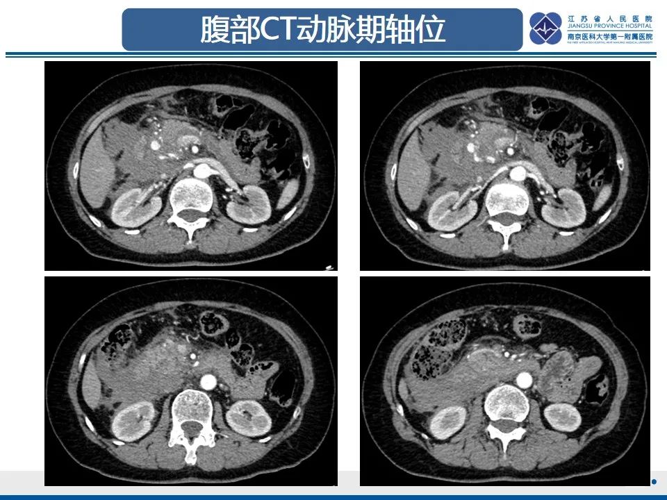 影像PPT - 【PPT】肠系膜上动脉假性动脉瘤-4