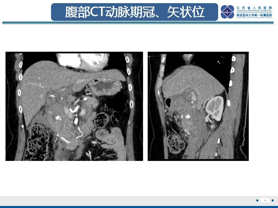 影像PPT - 【PPT】肠系膜上动脉假性动脉瘤-6