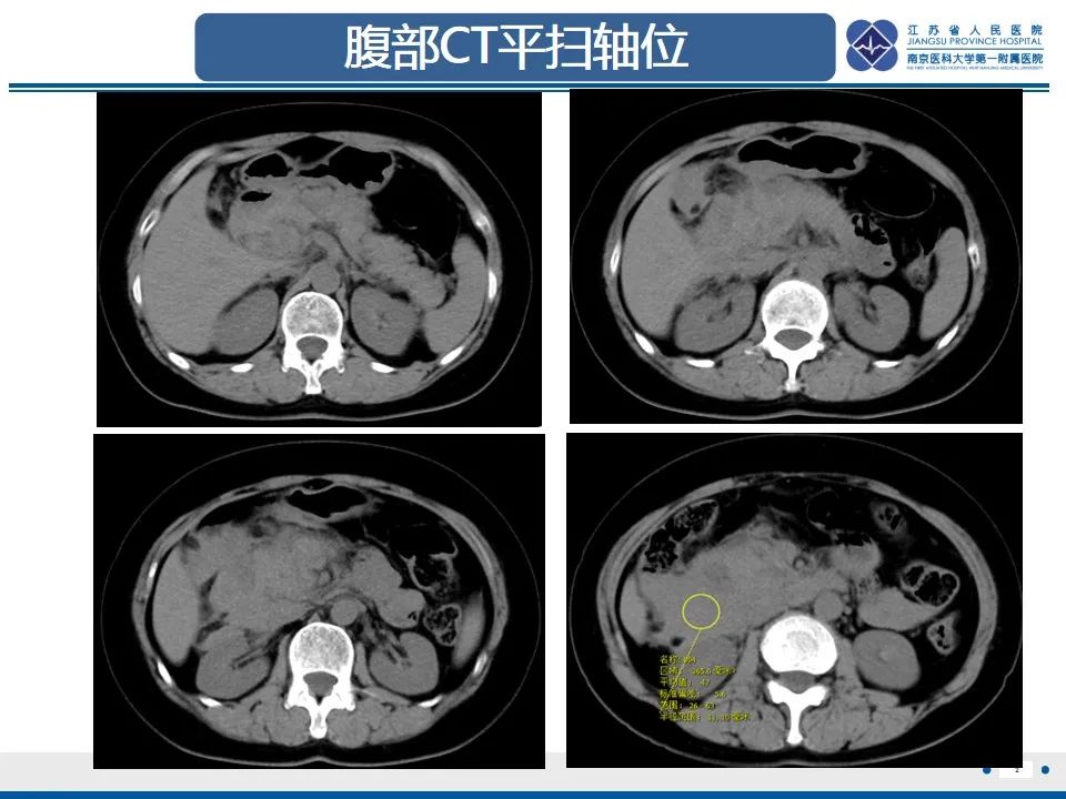影像PPT - 【PPT】肠系膜上动脉假性动脉瘤-3