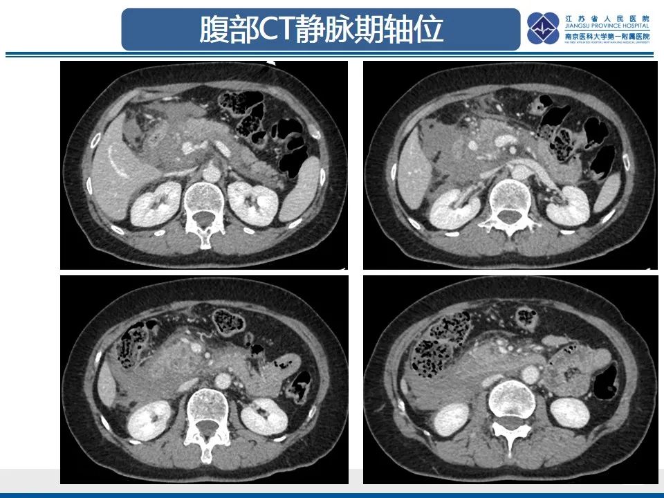 影像PPT - 【PPT】肠系膜上动脉假性动脉瘤-5