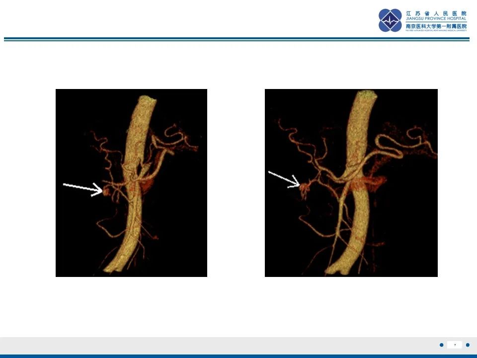 影像PPT - 【PPT】肠系膜上动脉假性动脉瘤-8