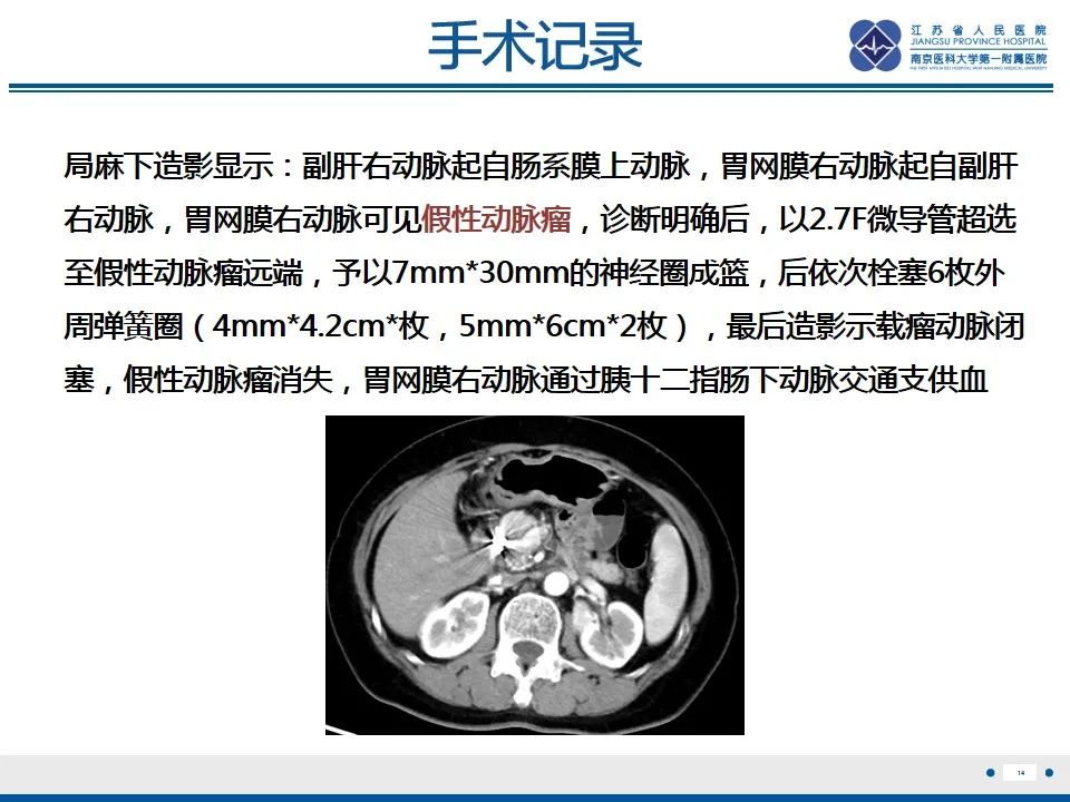 影像PPT - 【PPT】肠系膜上动脉假性动脉瘤-15
