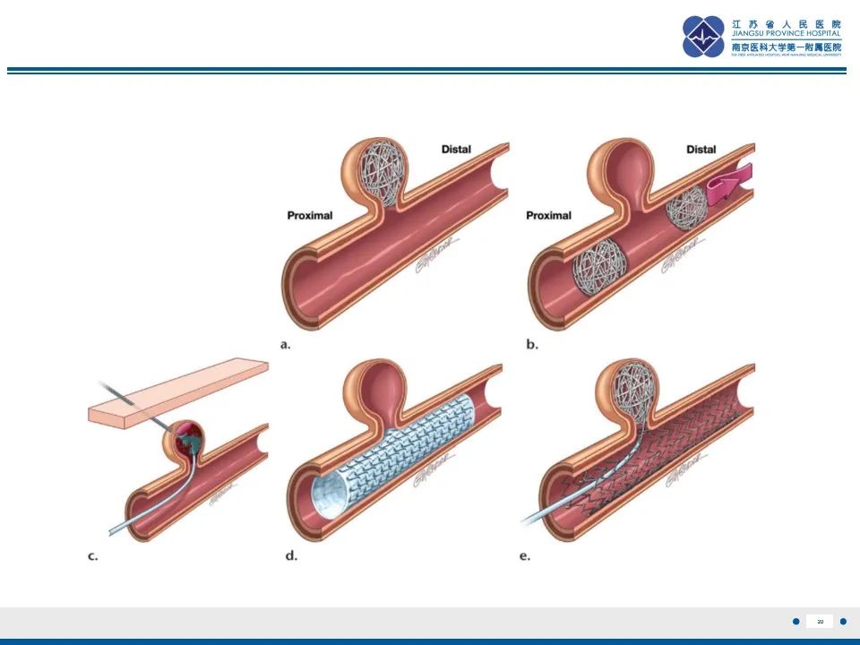 影像PPT - 【PPT】肠系膜上动脉假性动脉瘤-21