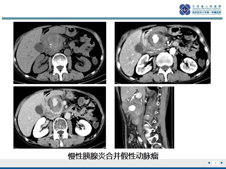 影像PPT - 【PPT】肠系膜上动脉假性动脉瘤-24