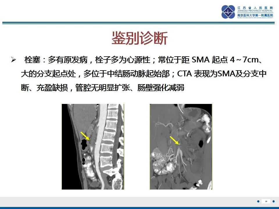 影像PPT - 【PPT】肠系膜上动脉假性动脉瘤-29