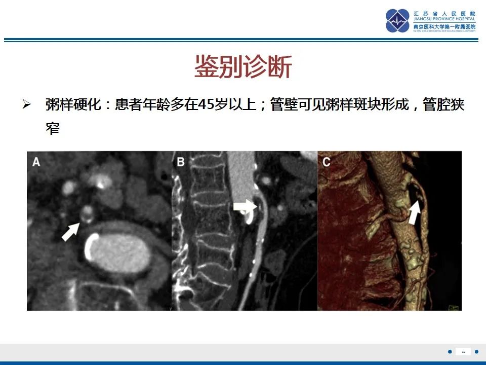 影像PPT - 【PPT】肠系膜上动脉假性动脉瘤-31