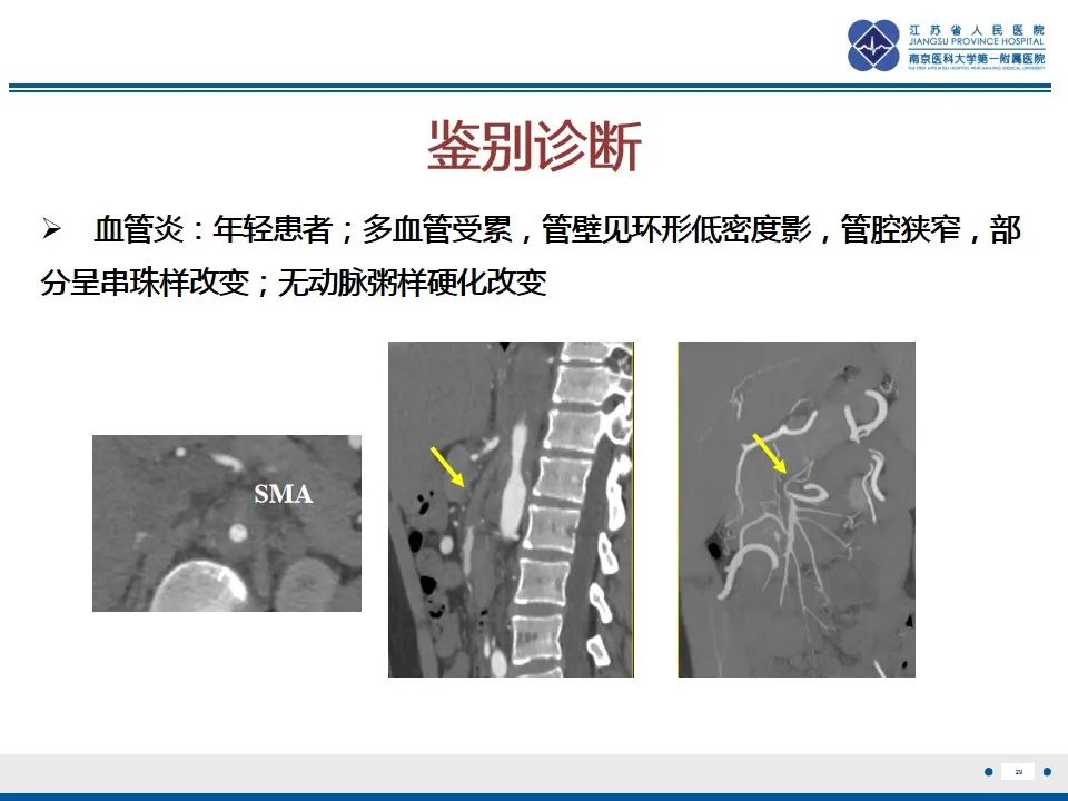 影像PPT - 【PPT】肠系膜上动脉假性动脉瘤-30