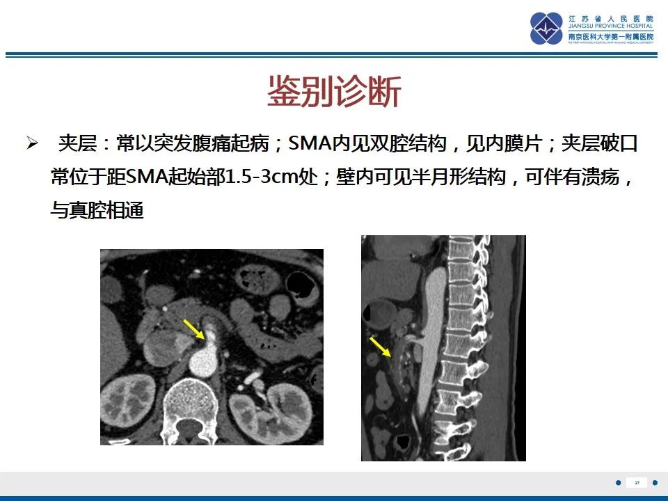 影像PPT - 【PPT】肠系膜上动脉假性动脉瘤-28