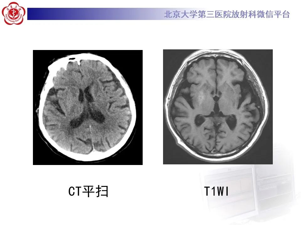 影像PPT - 【PPT】非酮症高血糖性偏侧舞蹈症-3