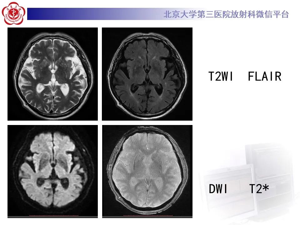 影像PPT - 【PPT】非酮症高血糖性偏侧舞蹈症-4
