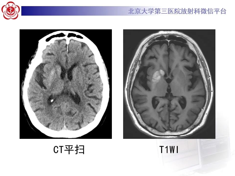 影像PPT - 【PPT】非酮症高血糖性偏侧舞蹈症-7