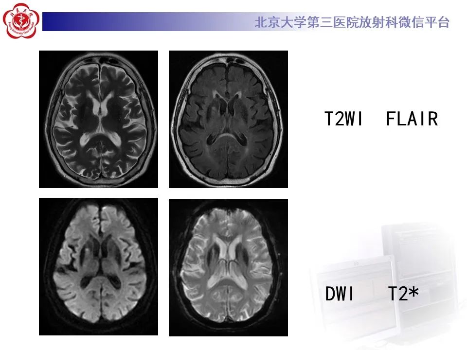 影像PPT - 【PPT】非酮症高血糖性偏侧舞蹈症-8