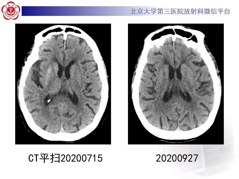 影像PPT - 【PPT】非酮症高血糖性偏侧舞蹈症-10