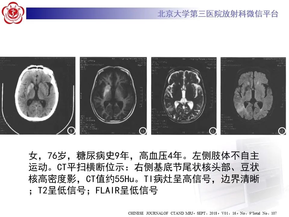 影像PPT - 【PPT】非酮症高血糖性偏侧舞蹈症-24