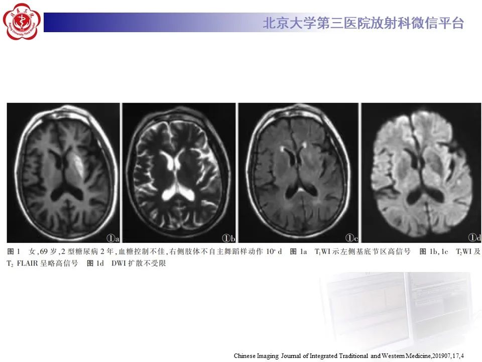 影像PPT - 【PPT】非酮症高血糖性偏侧舞蹈症-25
