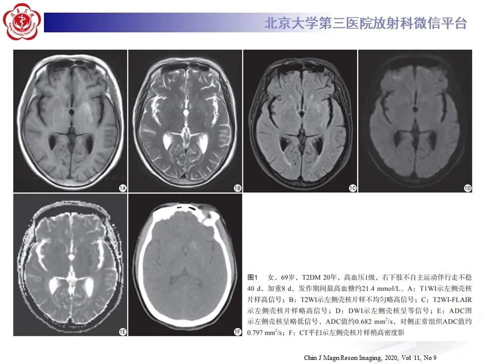 影像PPT - 【PPT】非酮症高血糖性偏侧舞蹈症-26